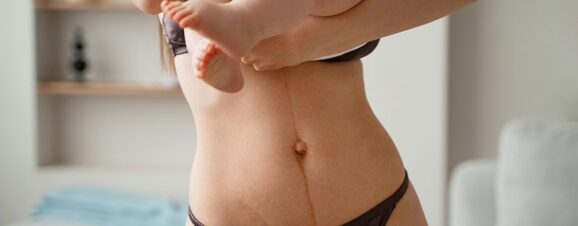 A woman holding her baby while displaying her C-section scar.