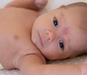 A baby with a stork bite on his forehead.