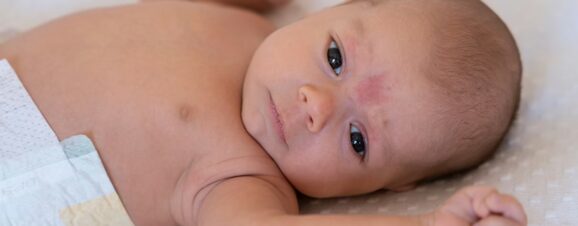 A baby with a stork bite on his forehead.