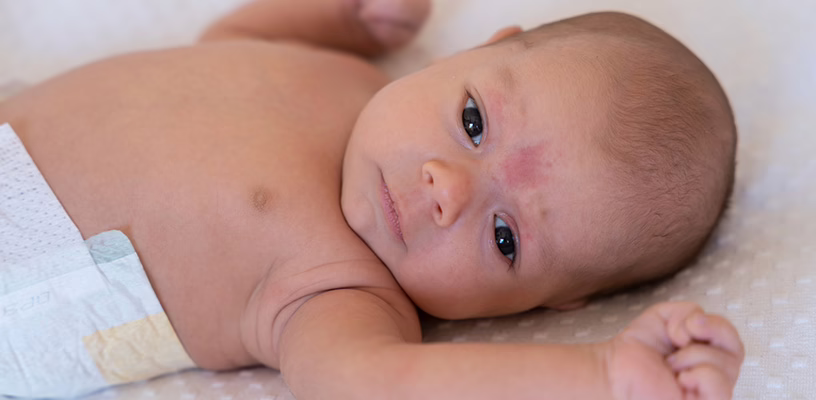 A baby with a stork bite on his forehead.