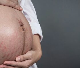 Close view of a woman's pregnant belly showing a PUPPP rash.
