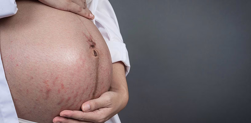 Close view of a woman's pregnant belly showing a PUPPP rash.